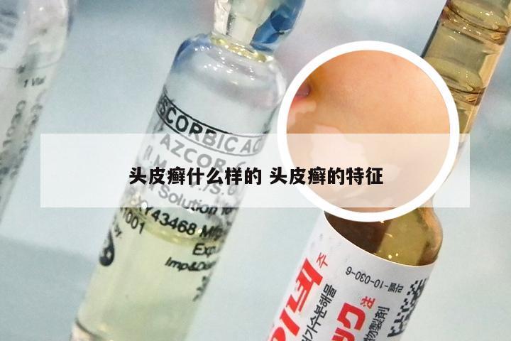 头皮癣什么样的 头皮癣的特征