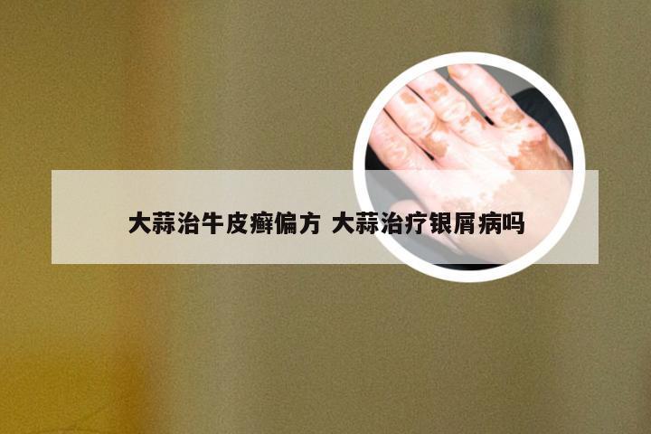 大蒜治牛皮癣偏方 大蒜治疗银屑病吗
