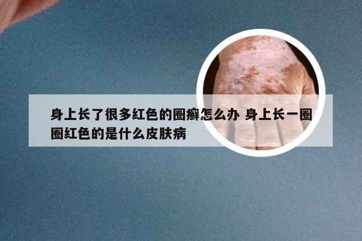 身上长了很多红色的圈癣怎么办 身上长一圈圈红色的是什么皮肤病