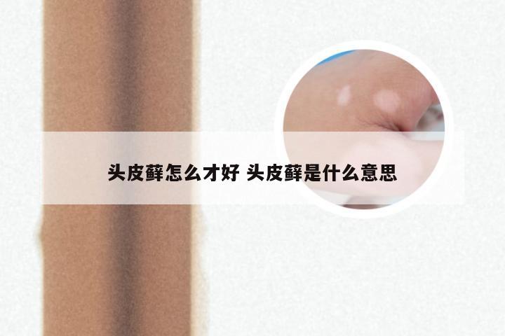 头皮藓怎么才好 头皮藓是什么意思