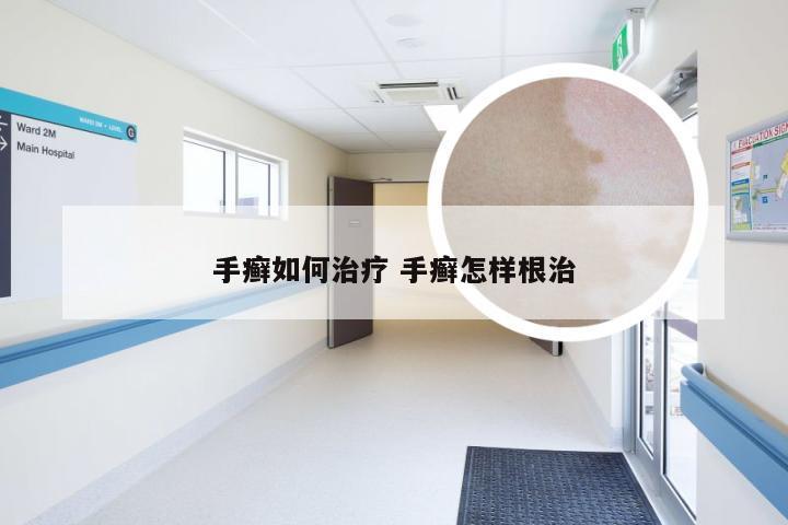 手癣如何治疗 手癣怎样根治