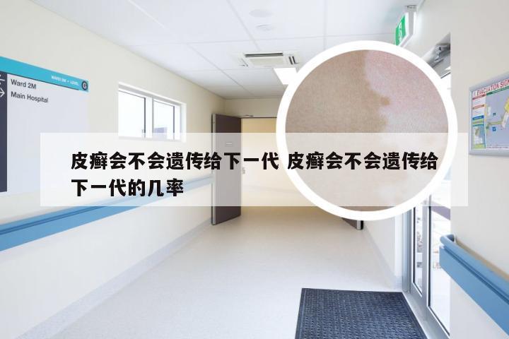 皮癣会不会遗传给下一代 皮癣会不会遗传给下一代的几率