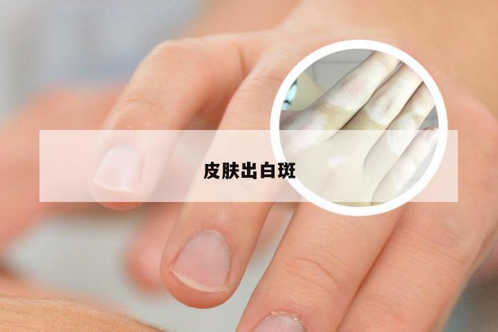 皮肤出白斑