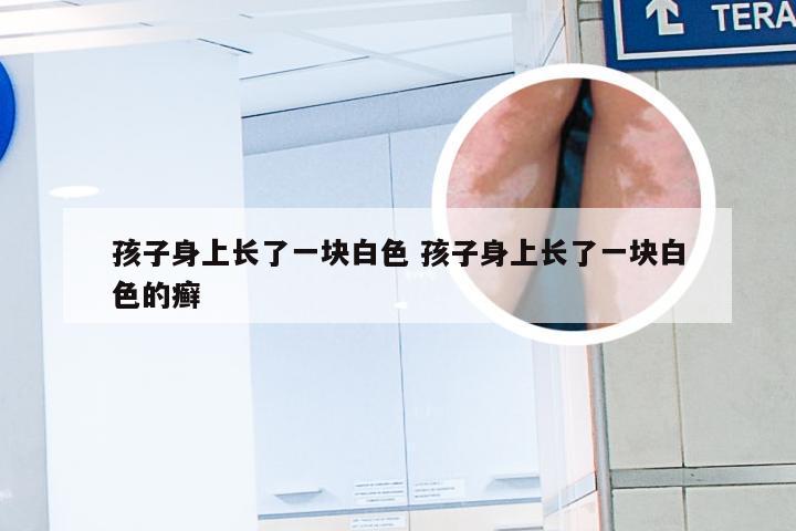 孩子身上长了一块白色 孩子身上长了一块白色的癣