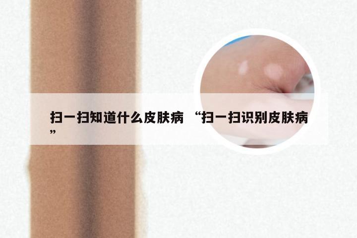 扫一扫知道什么皮肤病 “扫一扫识别皮肤病”