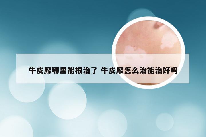牛皮廨哪里能根治了 牛皮廨怎么治能治好吗