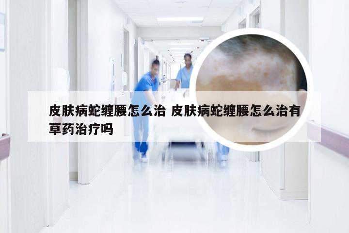 皮肤病蛇缠腰怎么治 皮肤病蛇缠腰怎么治有草药治疗吗