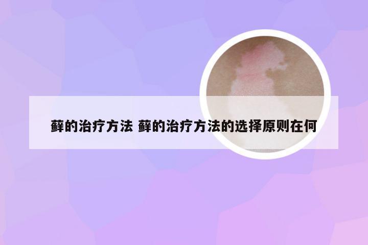 藓的治疗方法 藓的治疗方法的选择原则在何