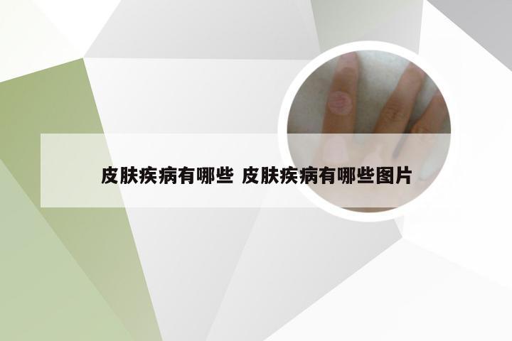 皮肤疾病有哪些 皮肤疾病有哪些图片