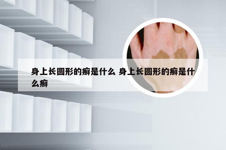 身上长圆形的癣是什么 身上长圆形的癣是什么癣
