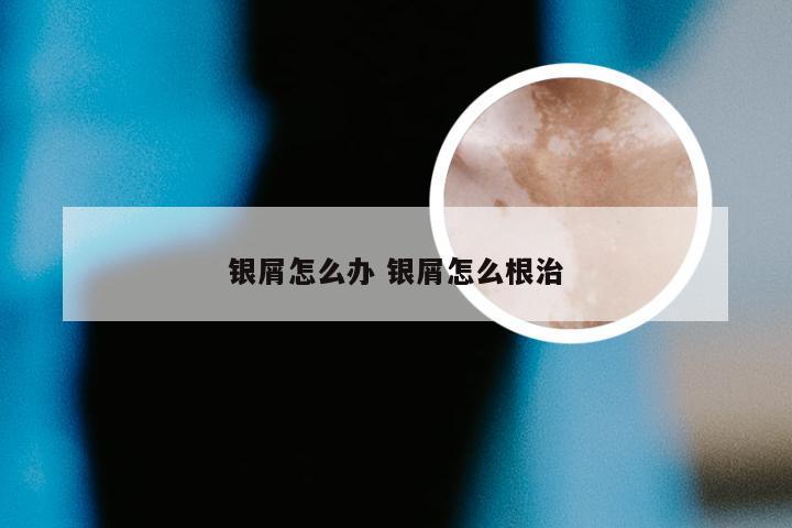银屑怎么办 银屑怎么根治