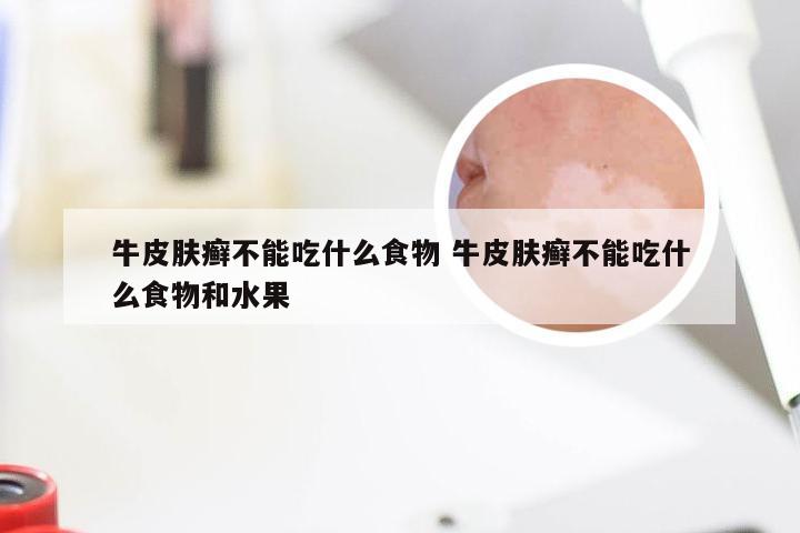 牛皮肤癣不能吃什么食物 牛皮肤癣不能吃什么食物和水果