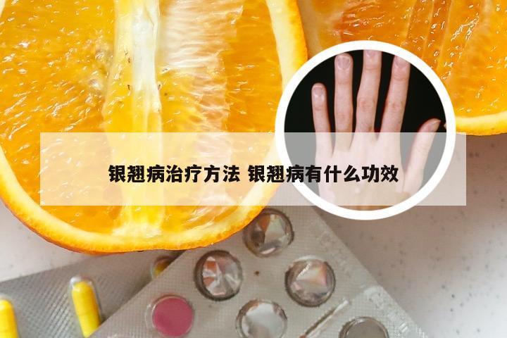 银翘病治疗方法 银翘病有什么功效