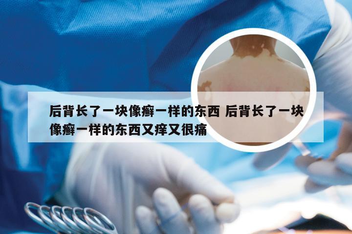 后背长了一块像癣一样的东西 后背长了一块像癣一样的东西又痒又很痛