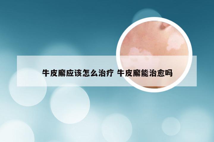 牛皮廨应该怎么治疗 牛皮廨能治愈吗