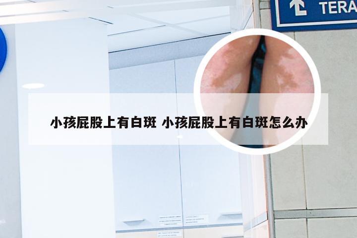 小孩屁股上有白斑 小孩屁股上有白斑怎么办
