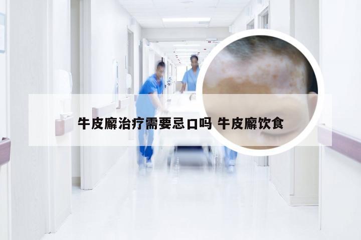 牛皮廨治疗需要忌口吗 牛皮廨饮食