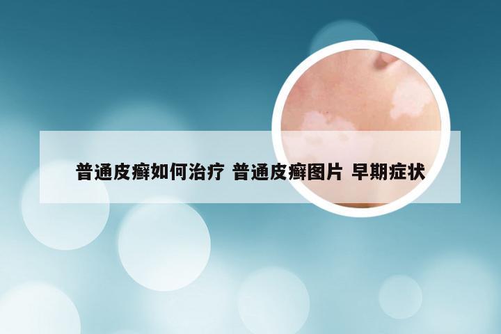 普通皮癣如何治疗 普通皮癣图片 早期症状