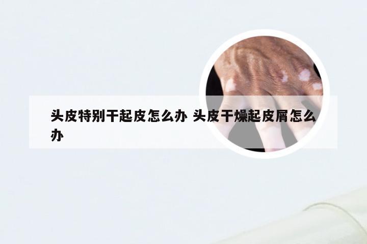 头皮特别干起皮怎么办 头皮干燥起皮屑怎么办
