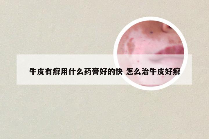 牛皮有癣用什么药膏好的快 怎么治牛皮好癣