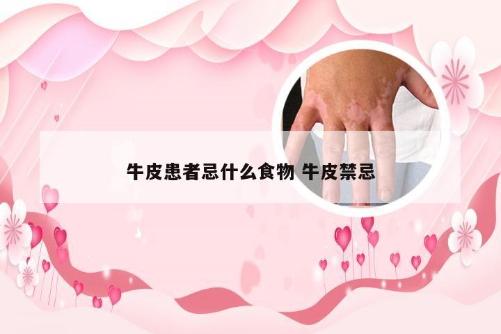 牛皮患者忌什么食物 牛皮禁忌