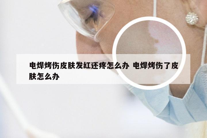 电焊烤伤皮肤发红还疼怎么办 电焊烤伤了皮肤怎么办