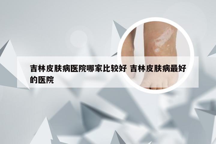 吉林皮肤病医院哪家比较好 吉林皮肤病最好的医院