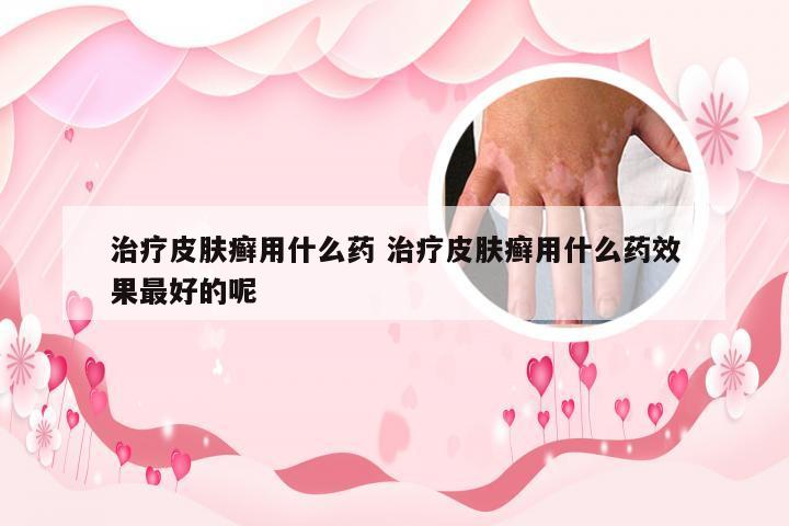 治疗皮肤癣用什么药 治疗皮肤癣用什么药效果最好的呢