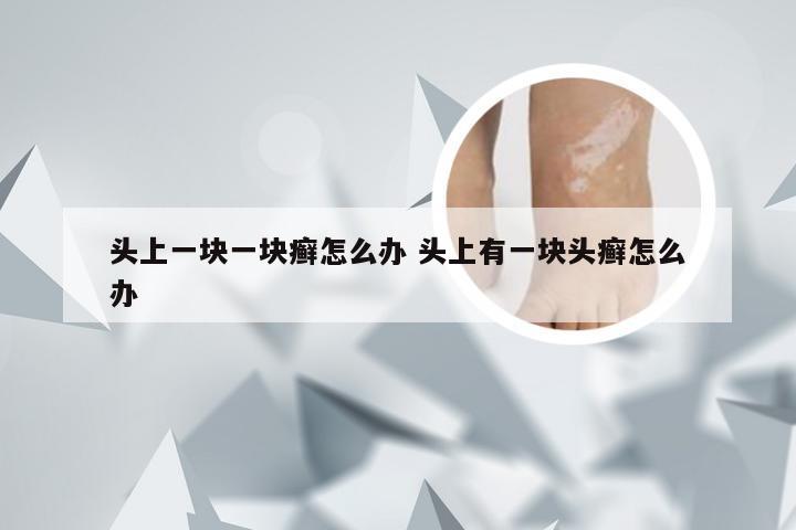 头上一块一块癣怎么办 头上有一块头癣怎么办