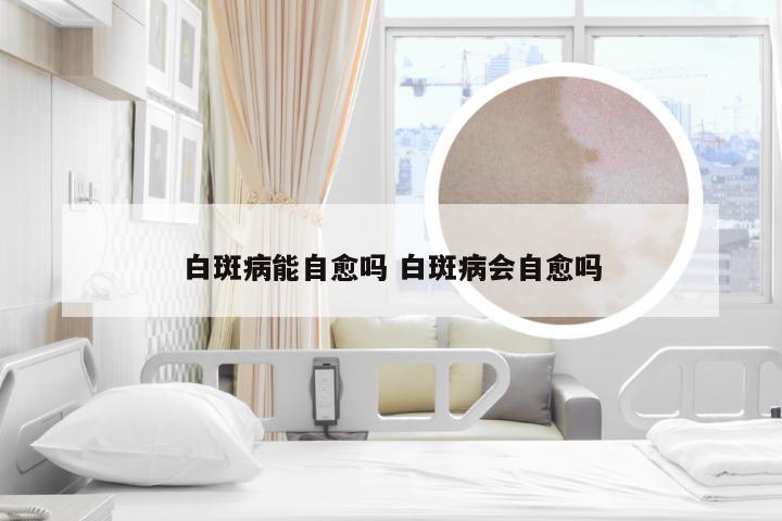 白斑病能自愈吗 白斑病会自愈吗