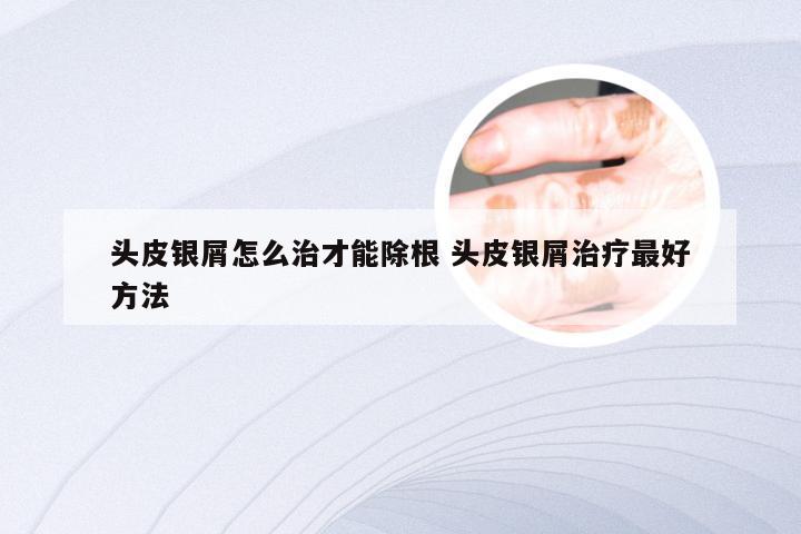 头皮银屑怎么治才能除根 头皮银屑治疗最好方法