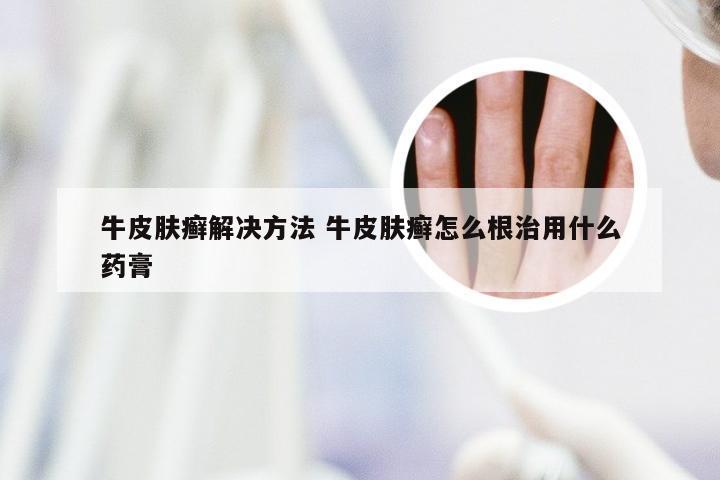 牛皮肤癣解决方法 牛皮肤癣怎么根治用什么药膏