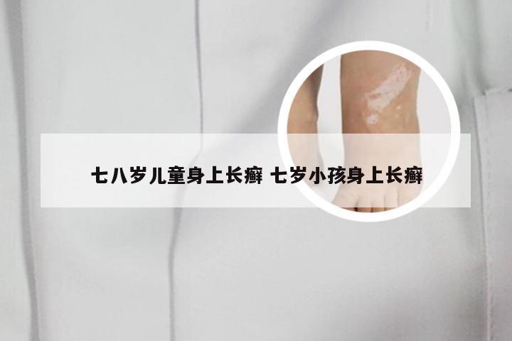 七八岁儿童身上长癣 七岁小孩身上长癣
