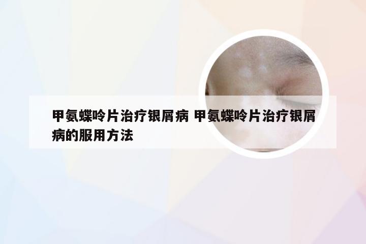 甲氨蝶呤片治疗银屑病 甲氨蝶呤片治疗银屑病的服用方法