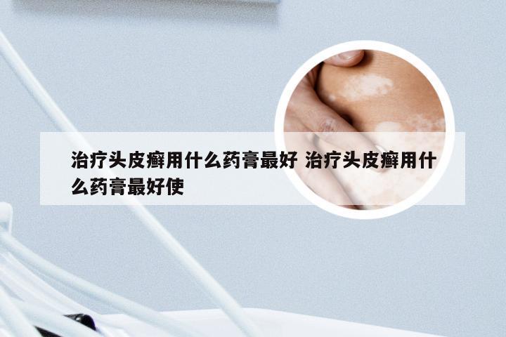 治疗头皮癣用什么药膏最好 治疗头皮癣用什么药膏最好使