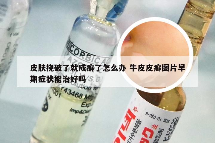 皮肤挠破了就成癣了怎么办 牛皮皮癣图片早期症状能治好吗