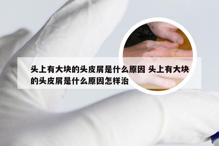 头上有大块的头皮屑是什么原因 头上有大块的头皮屑是什么原因怎样治