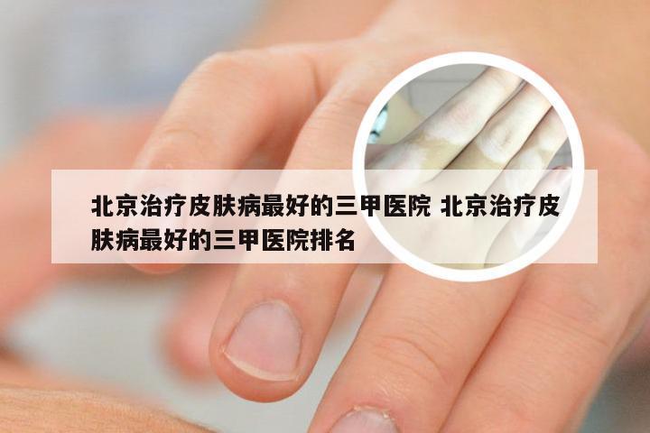 北京治疗皮肤病最好的三甲医院 北京治疗皮肤病最好的三甲医院排名