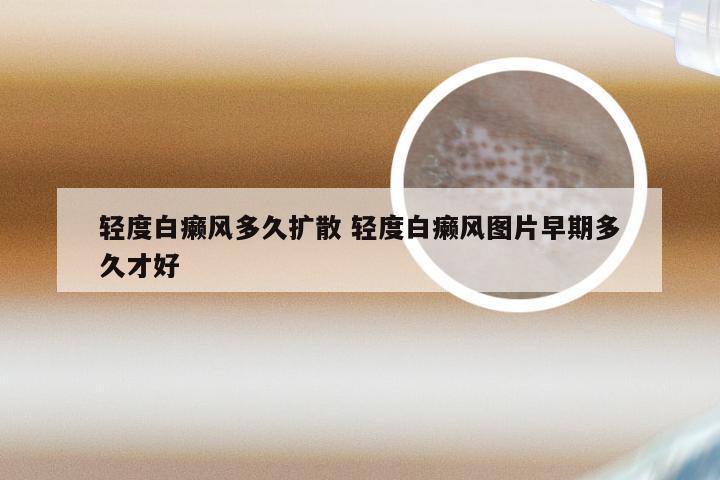 轻度白癞风多久扩散 轻度白癞风图片早期多久才好