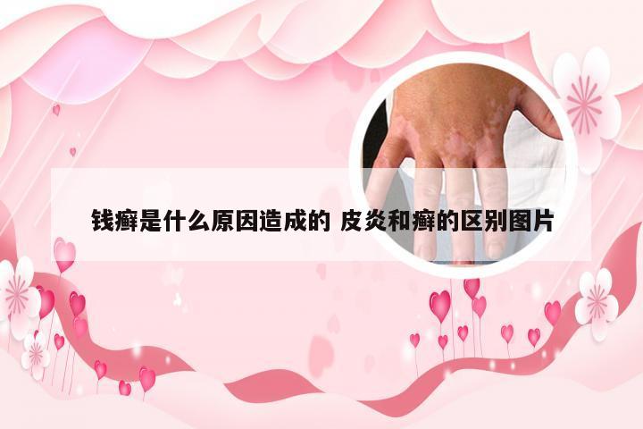 钱癣是什么原因造成的 皮炎和癣的区别图片