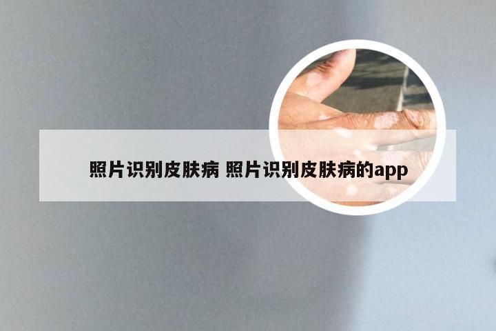 照片识别皮肤病 照片识别皮肤病的app