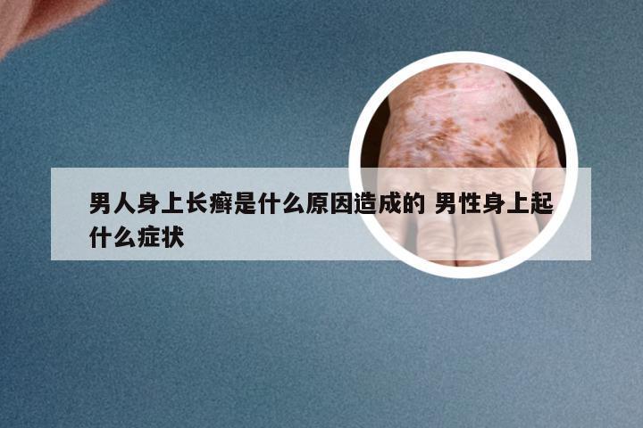 男人身上长癣是什么原因造成的 男性身上起什么症状
