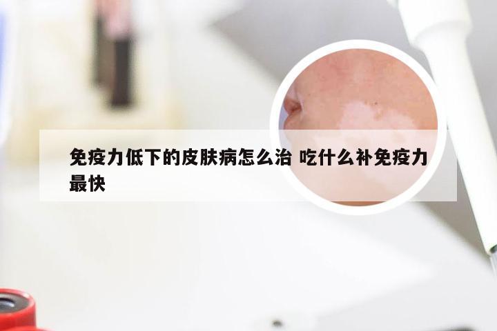 免疫力低下的皮肤病怎么治 吃什么补免疫力最快