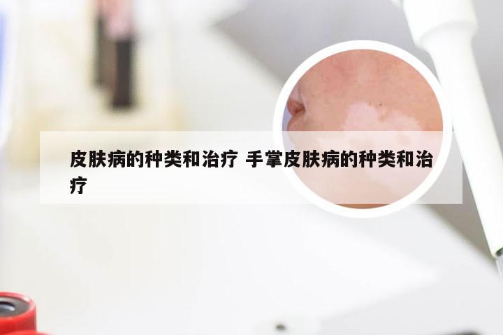 皮肤病的种类和治疗 手掌皮肤病的种类和治疗