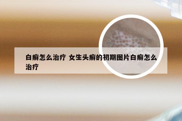 白癣怎么治疗 女生头癣的初期图片白癣怎么治疗