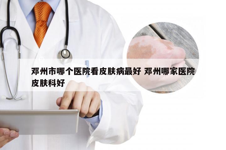 邓州市哪个医院看皮肤病最好 邓州哪家医院皮肤科好