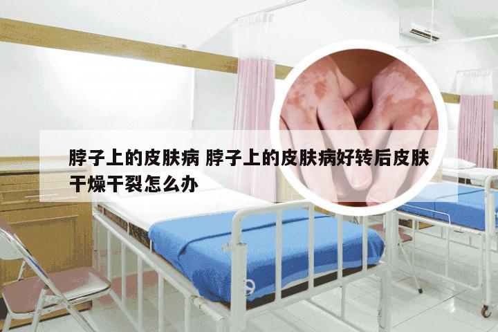 脖子上的皮肤病 脖子上的皮肤病好转后皮肤干燥干裂怎么办