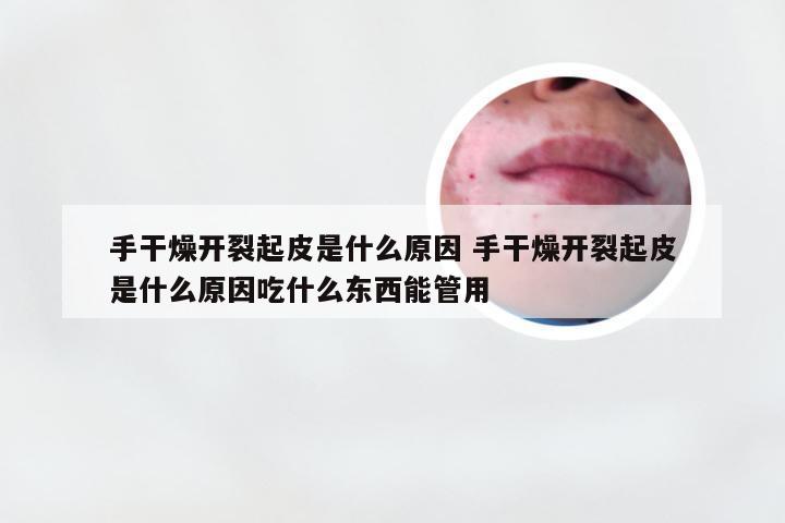 手干燥开裂起皮是什么原因 手干燥开裂起皮是什么原因吃什么东西能管用
