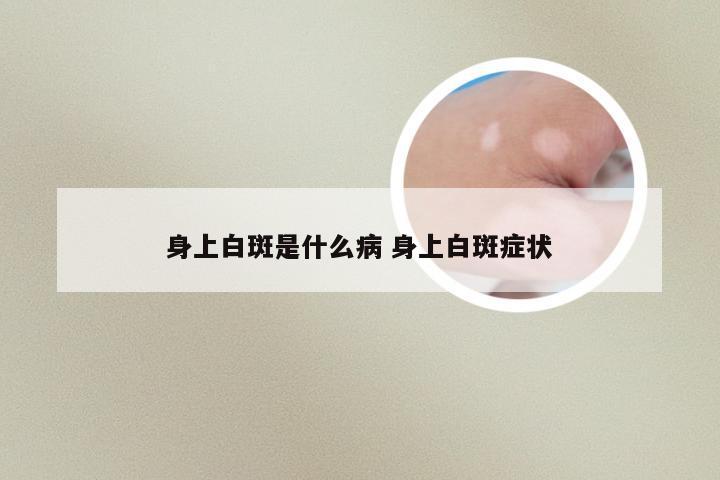 身上白斑是什么病 身上白斑症状