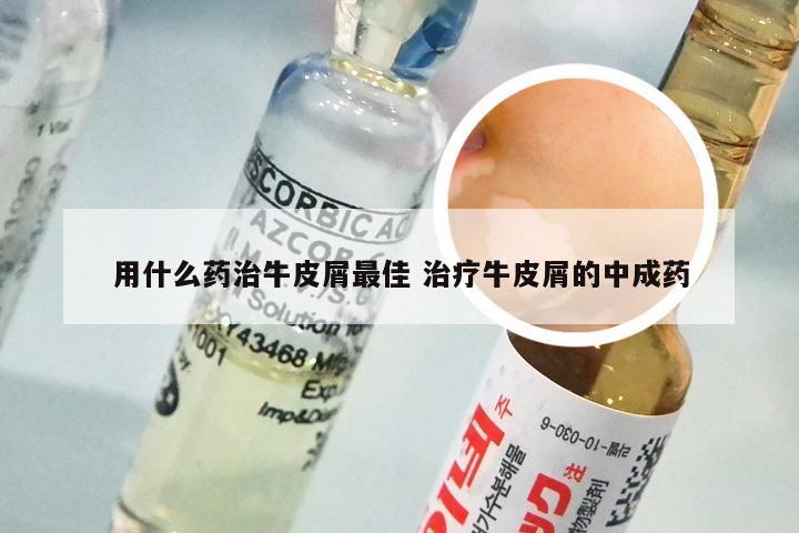 用什么药治牛皮屑最佳 治疗牛皮屑的中成药